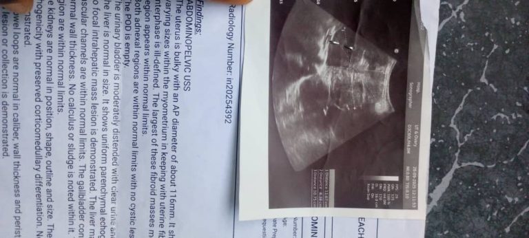 Assist A Sister With Uterine Fibroid